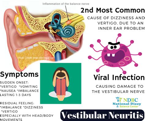 Vestibular Neuritis Is The Second Most Common Cause Of Dizziness And