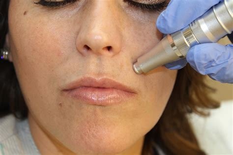 Microneedling For Lip Lines And Small Scars Skincare Physicians