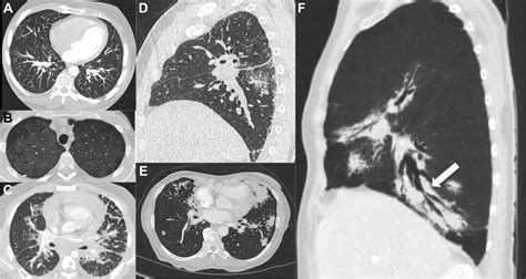 Lung Involvement In Destombes Rosai Dorfman Disease Chest