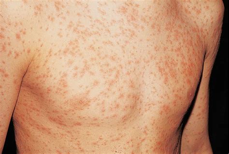 Skin Rash Causes Baby Skin Rash Allergy Fungal And Treatment