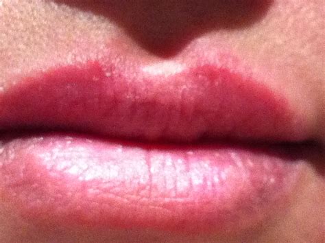 My Upper Lipvery Small Red Rash And Swellingpsoriasislip Balmlip