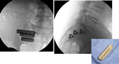 Sacroiliac Si Joint Fusion For Sacroiliac Degenerative Disease Cns Org