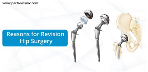 Hip Revision Surgery In Jaipur By Dr Arun Partani Clinic