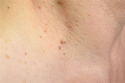 How To Treat Plane Warts And Common Warts Skincentral Dermatology