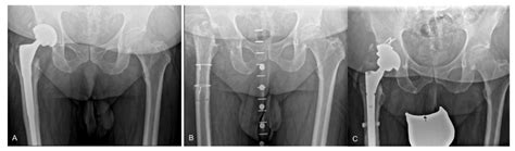 Jcm Free Full Text Extended Trochanteric Osteotomy With