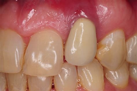 3 Dental Implant Gum Recession Peri Implantitis Infection Poorly
