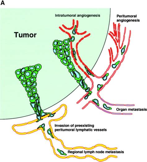 A Traditional Model Of Tumor Metastasis Via Lymphatic Open I