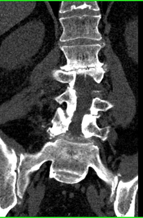 Degenerative Joint Disease Djd Of Lumbar Spine Musculoskeletal Case