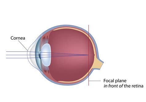 Myopia Nearsightedness Cypress Eye Centre