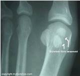 Tibial Sesamoid Fracture Treatment Pictures