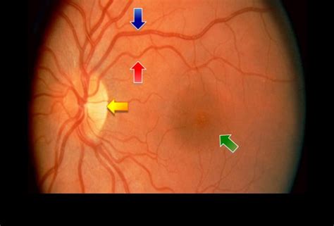 Retina Abnormalities 14 Signs Of Systemic Disease