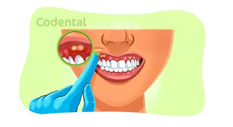 Abscesso No Dente Causa Sintoma E Muito Mais