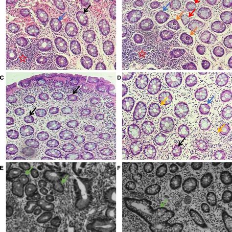 Pathological Changes In Ulcerative Colitis Crypt Structure