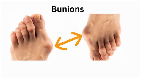 Causes Symptoms And Treatment Of Bunions Kechyelathrive