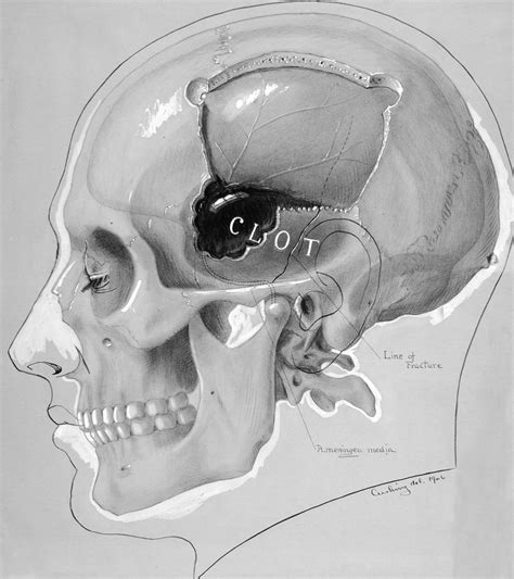 Epidural Hematoma The Neurosurgical Atlas By Aaron Cohen Gadol Md