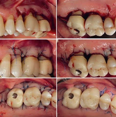 Chronic Periodontitis Pocket Dentistry