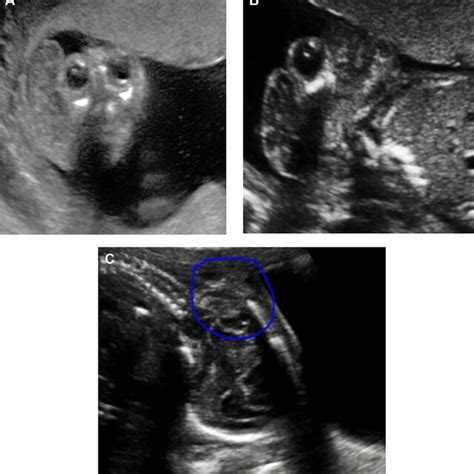 Ultrasound Images Of Fetus With Ntds A Anencephaly Case “mickey