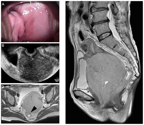 Extranodal Marginal Zone Lymphoma Of The Uterine Cervix With