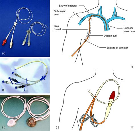 Central Venous Catheter Ports