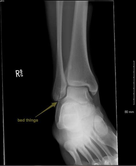 Ankle X Ray Fibula Chip Fractures And Low Ankle Sprain Mike Matz
