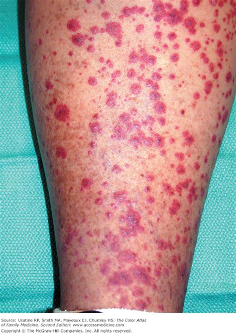 Allergic Vasculitis As Related To Permanent Damage To The Blood Vessels