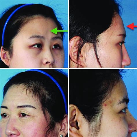 Illustration Of Depth Of Forehead Fat Injection Tiny Aliquots Of Fat