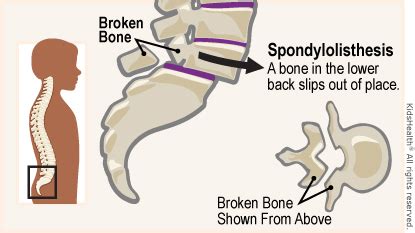 I need, quite simply, to send the user back when they click a back button. Spondylolisthesis (for Parents) - Nemours KidsHealth