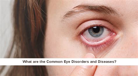 Common Eye Disorders And Diseases