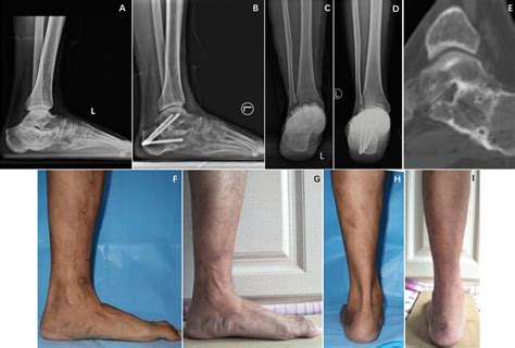 A 35 Year Old Male Patient With Left Calcaneal Malunion For 14 Months