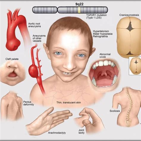 Characteristic Phenotype Of Marfan Syndrome Download Scientific Diagram