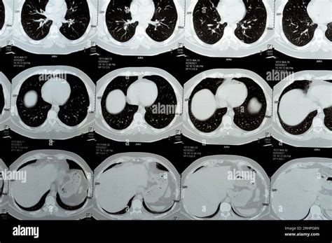 Multi Slice Ct Scan Of The Chest Showing Normal Study Normal