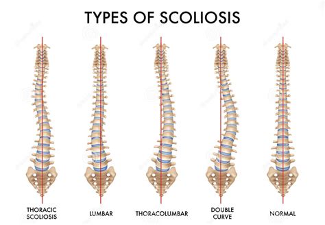 Scoliosis Back Conditions Treatment Kaizo Health Chiro And Rehab