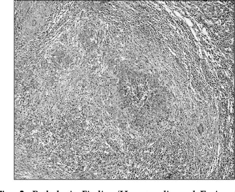 Figure 2 From A Case Report Of Isolated Inguinal Tuberculous