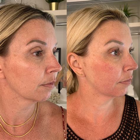 Forma Facial Toronto Skin Tightening Toronto Body Fx Forma Facial Forma Plus — Schulz