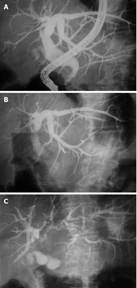 Endoscopic Retrograde Cholangio Pancreatography Showing Gradual Resolve