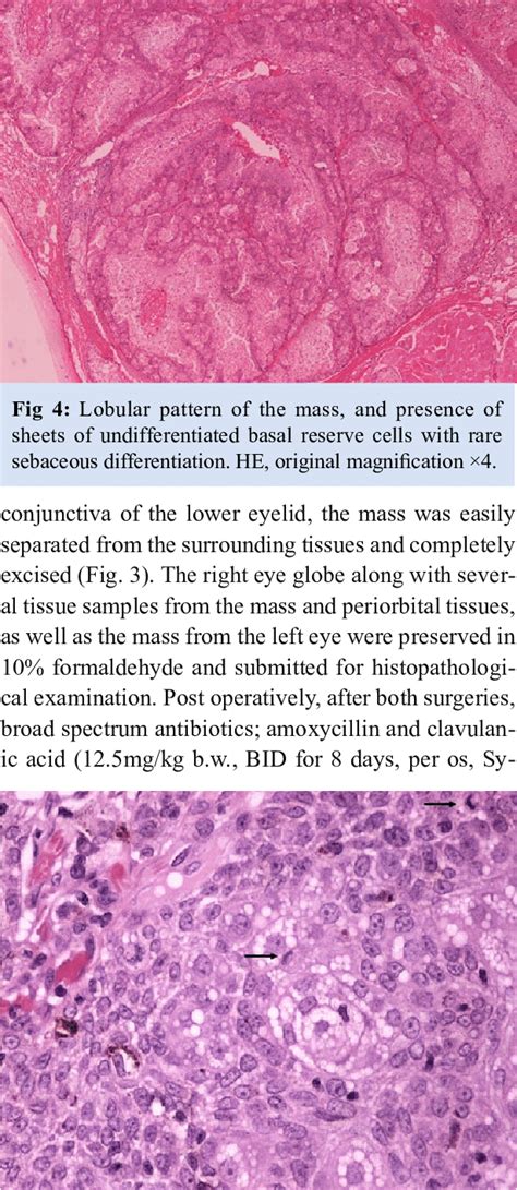 Growth Of Basaloid Cells With Scattered Aggregates Of Sebocytes And