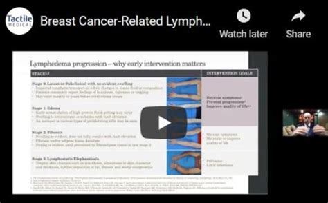 Breast Cancer Related Lymphedema And Management Modern Risk Assessment