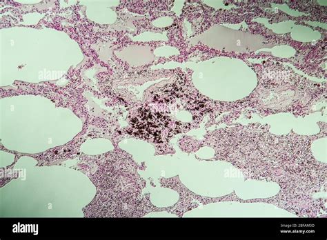 Lung Tissue As Dust Lung Under The Microscope 100x Stock Photo Alamy