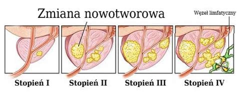 Rak Prostaty Objawy Przyczyny I Leczenie Nowotworu Stercza 51968 The