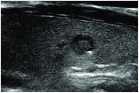 The role of sonography in thyroid cancer. Does Your Thyroid Cancer Look Like These Examples? These ...