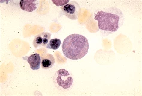 Pathology Outlines Eosinophils