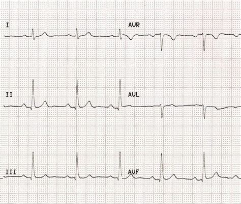 Section Of A Normal Ecg Lead Ii