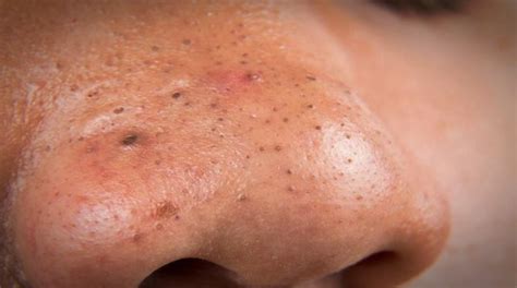 Eliminate Blackheads Using This Really Easy And Effective Trick Try