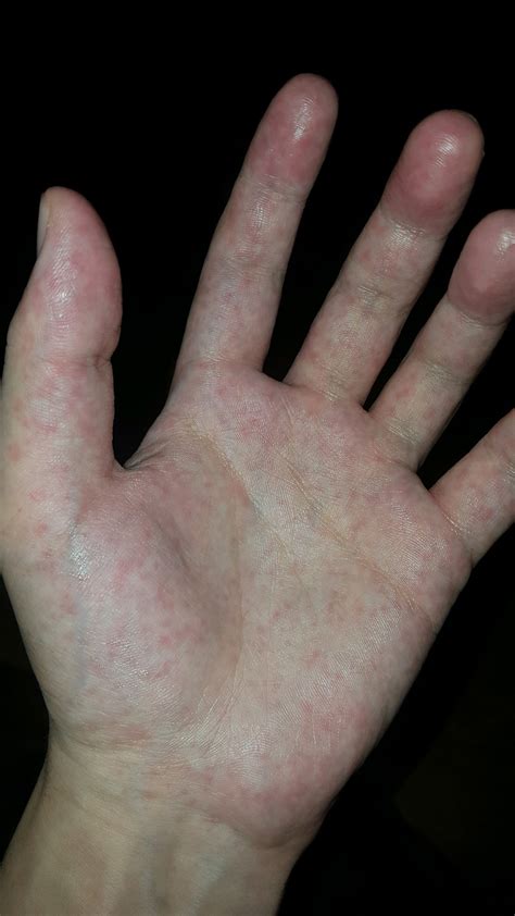 Tiny Itchy Red Dots On My Palms Started Appearing On My Palms About 2