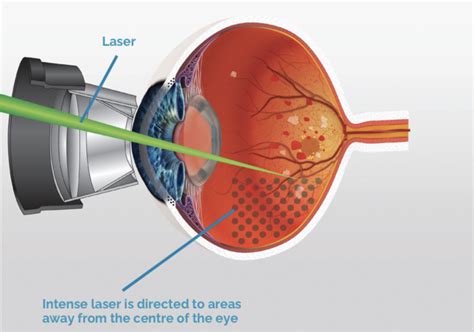 Retinal Hole Laser Treatment Synergy Eye Care