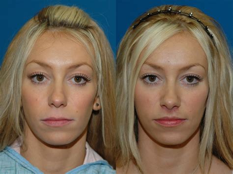Before And After Philtrum Shortening Postimages
