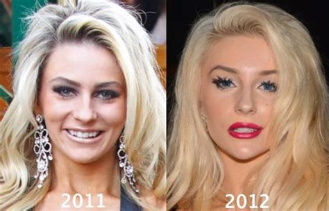 Courtney Stodden Plastic Surgery Before And After 2011 2012 Plastic