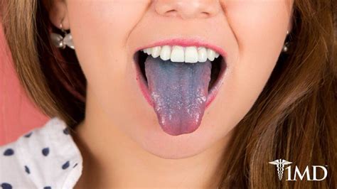 From Food To Medical Concerns 8 Reasons Why Your Tongue Is Purple