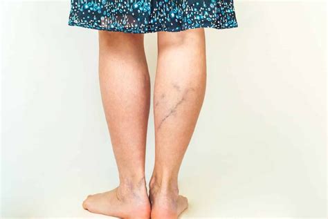 How Varicose Veins Are More Than A Cosmetic Issue