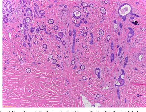 Pdf Microcystic Adnexal Carcinoma Of The Scalp In An African American